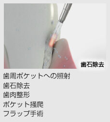 歯周病レーザー治療